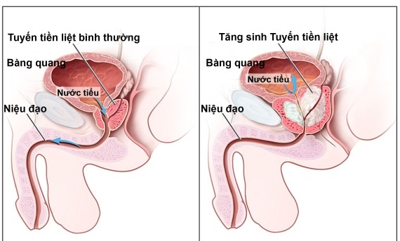 Ung thư tuyến tiền liệt và ung thư phổi 
